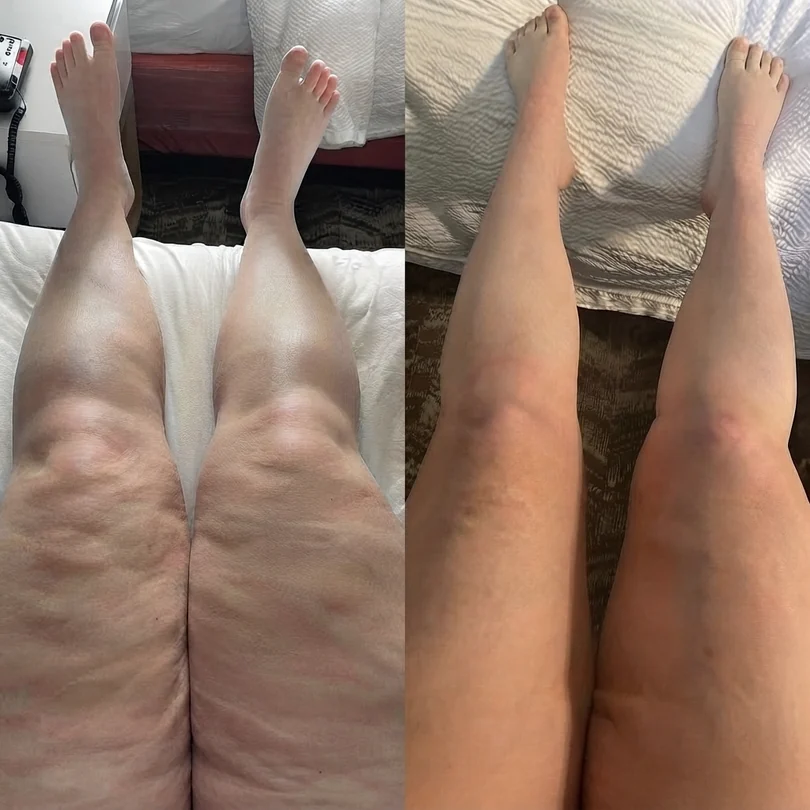 Before and after legs and ankles